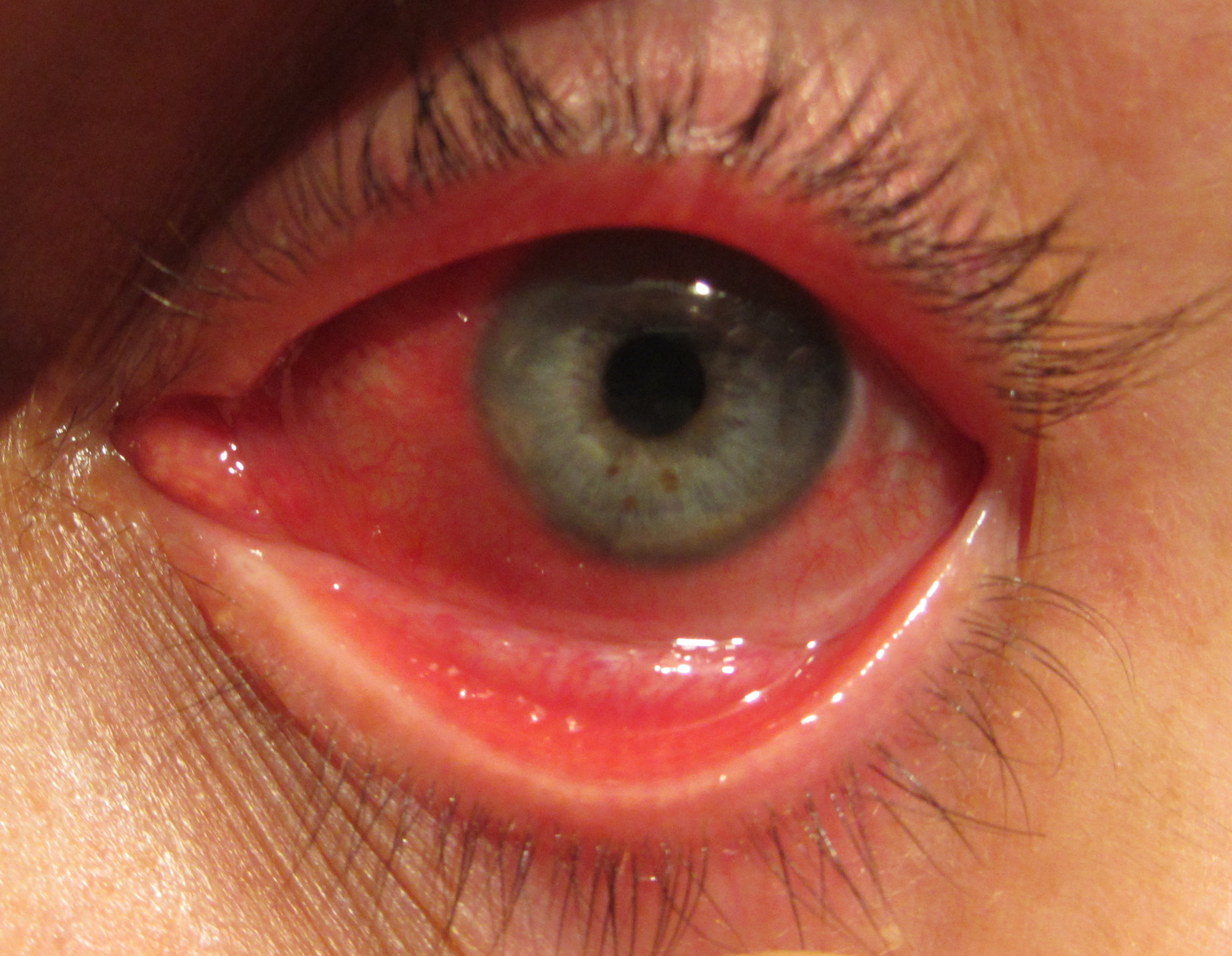 Encuentran síntomas oculares producidos por COVID-19 1
