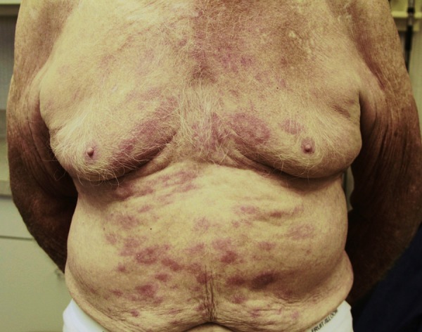 El primer síntoma del coronavirus se presenta en la piel 1
