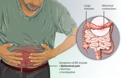 como combatir colon irritable