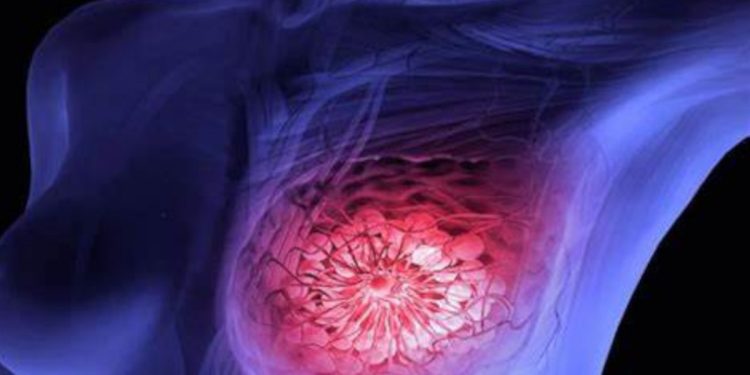 cancer de mama metastasico - Digital de León