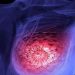 cancer de mama metastasico - Digital de León